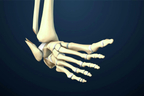 Ankle Fracture Repair.jpg