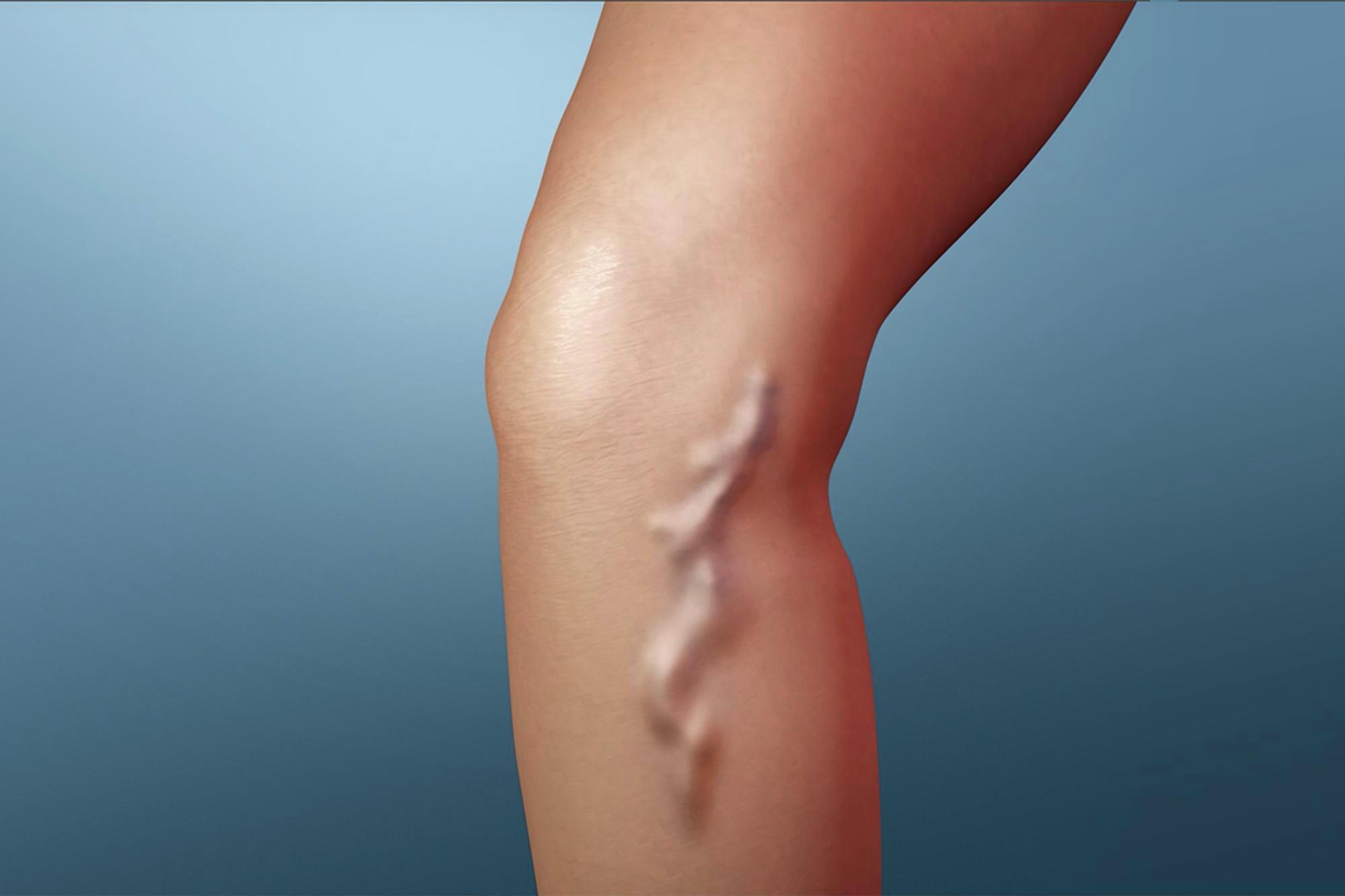 Sclerotherapy Vein Treatment - The Cardiovascular Institute: Vein