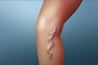 Treatment for Varicose Veins.jpg