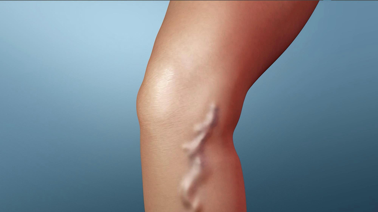 Minimally Invasive Varicose Vein Surgery and Removal in Baltimore