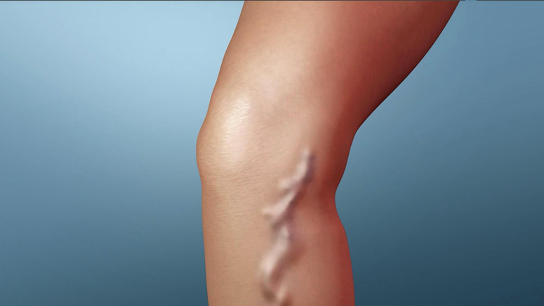 Varicose Veins Treated by Vascular Doctors in Baltimore - Mercy