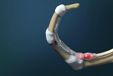 Trigger Finger (Stenosing Tenosynovitis).jpg