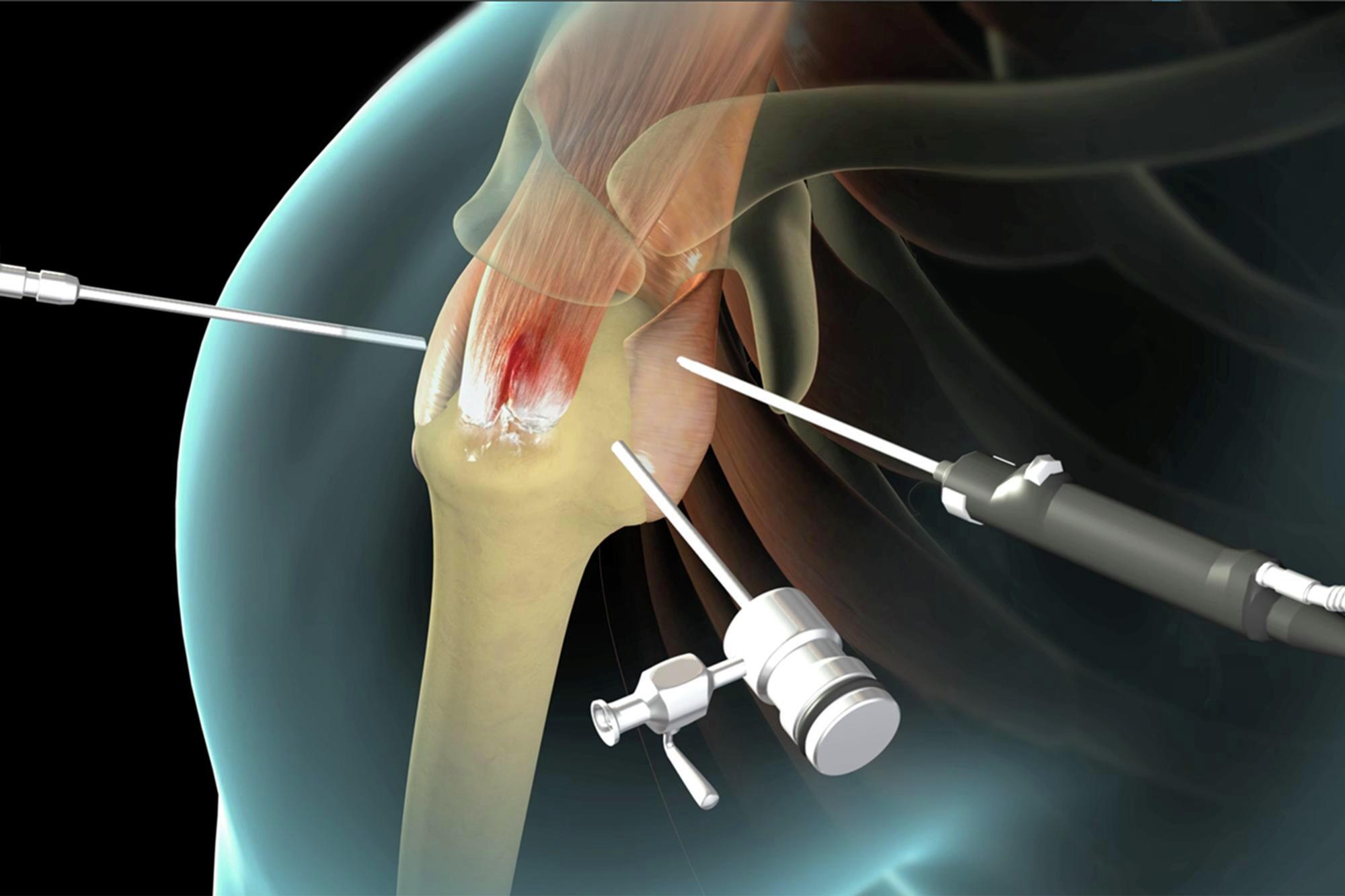 Repairing a Torn Rotator Cuff - New Jersey - High Mountain Orthopedics