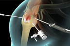 Arthroscopic Rotator Cuff Repair.jpg