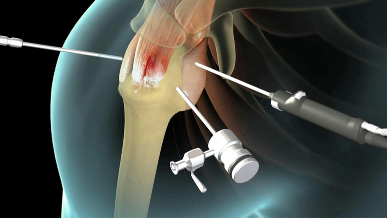 Rotator Cuff Tear - Center for Orthopedic Specialists