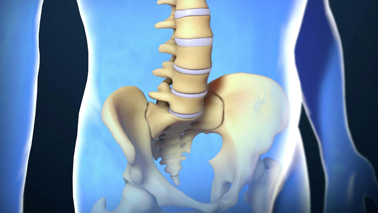 Lumbar Spinal Fusion.jpg