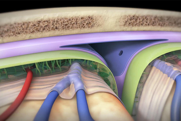 Craniotomy and Craniectomy.jpg