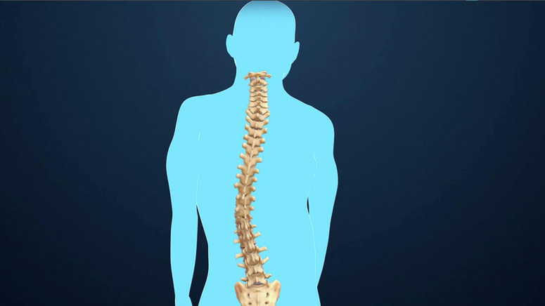 Scoliosis.jpg
