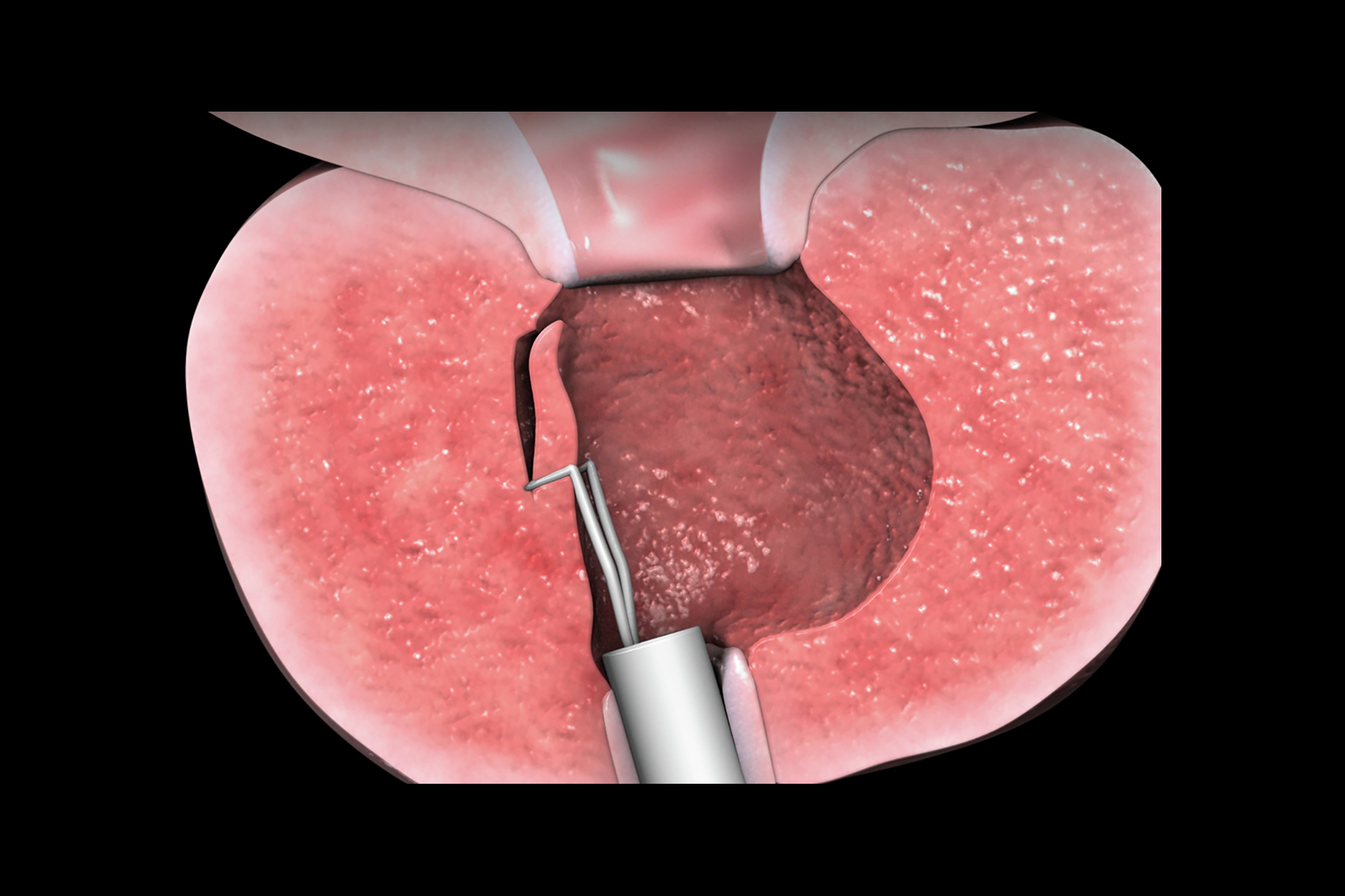 enlarged prostate gland