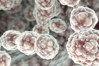 Cervical Cancer Progression and Staging.jpg