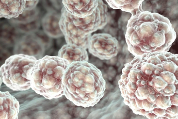 Cervical Cancer Progression and Staging.jpg