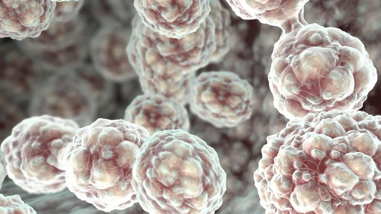 Cervical Cancer Progression and Staging.jpg