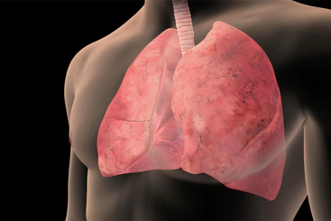 Lung Cancer Symptoms.jpg