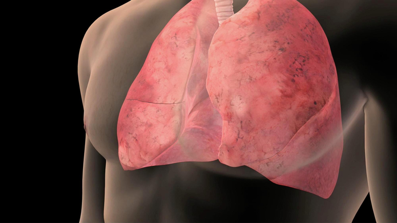 Lung Cancer Symptoms.jpg