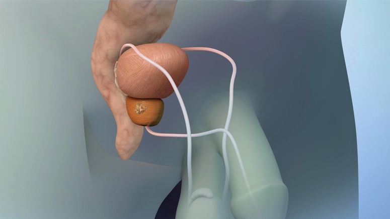 Treatment Options for Prostate Cancer.jpg