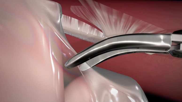 Laparoscopic Ventral and Incisional Hernia Repair.jpg