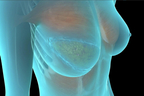 DIEP Breast Reconstruction.jpg