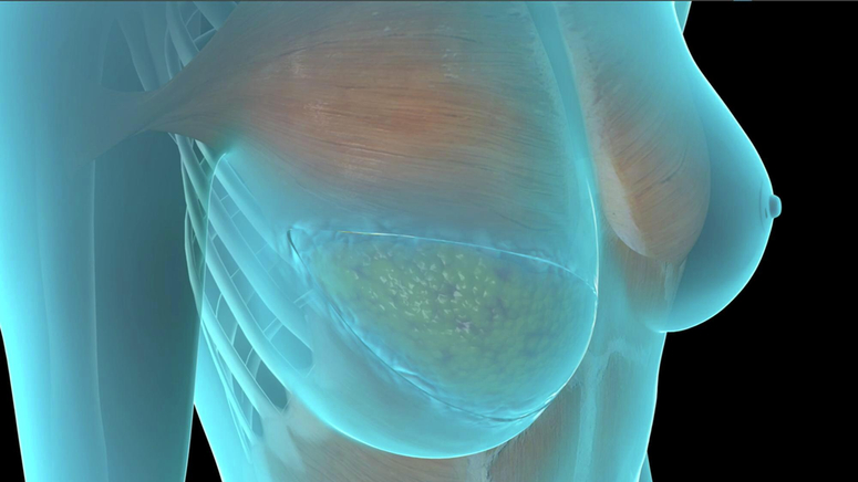 DIEP Flap Breast Reconstruction by Top Surgeons in Baltimore at Mercy