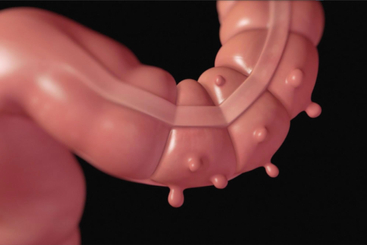 Diverticular Disease.jpg