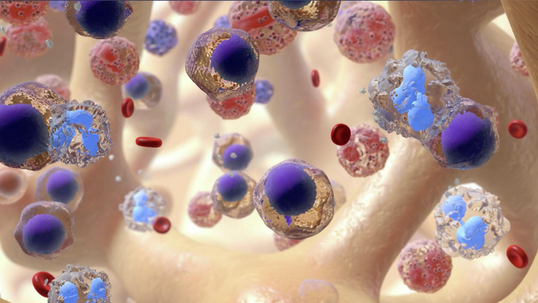 Treatment Options for Leukemia.jpg