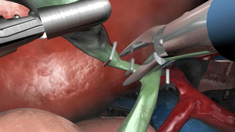 Cholecystectomy (Gallbladder Removal).jpg