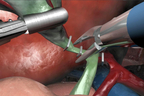 Cholecystectomy (Gallbladder Removal).jpg