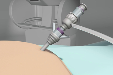 Robotic Gastric Sleeve.jpg