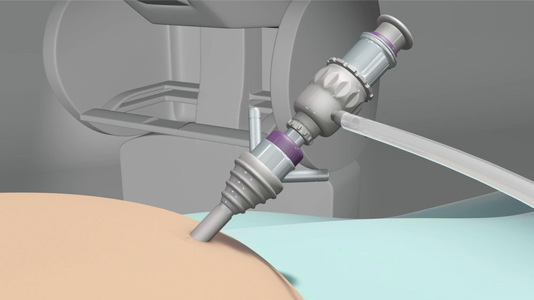 Robotic Gastric Sleeve.jpg