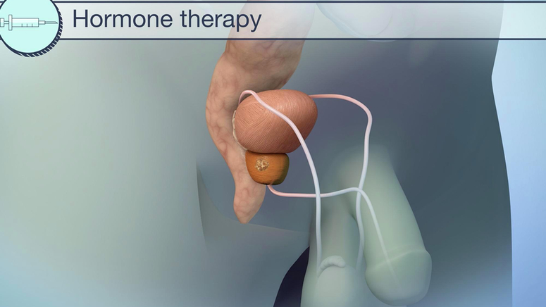 Managing Prostate Cancer.jpg