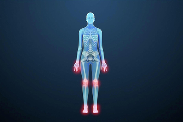 Rheumatoid Arthritis.jpg