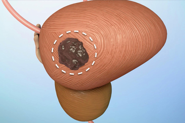 Treatment Options for Bladder Cancer.jpg