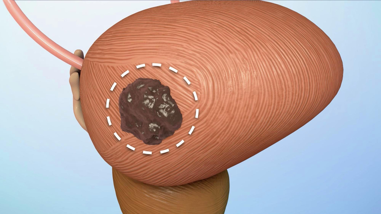 Treatment Options for Bladder Cancer.jpg