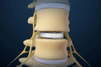 Lumbar Disc Replacement.jpg