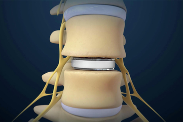 Lumbar Disc Replacement.jpg