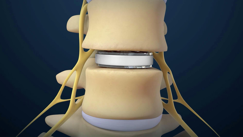 Lumbar Disc Replacement.jpg