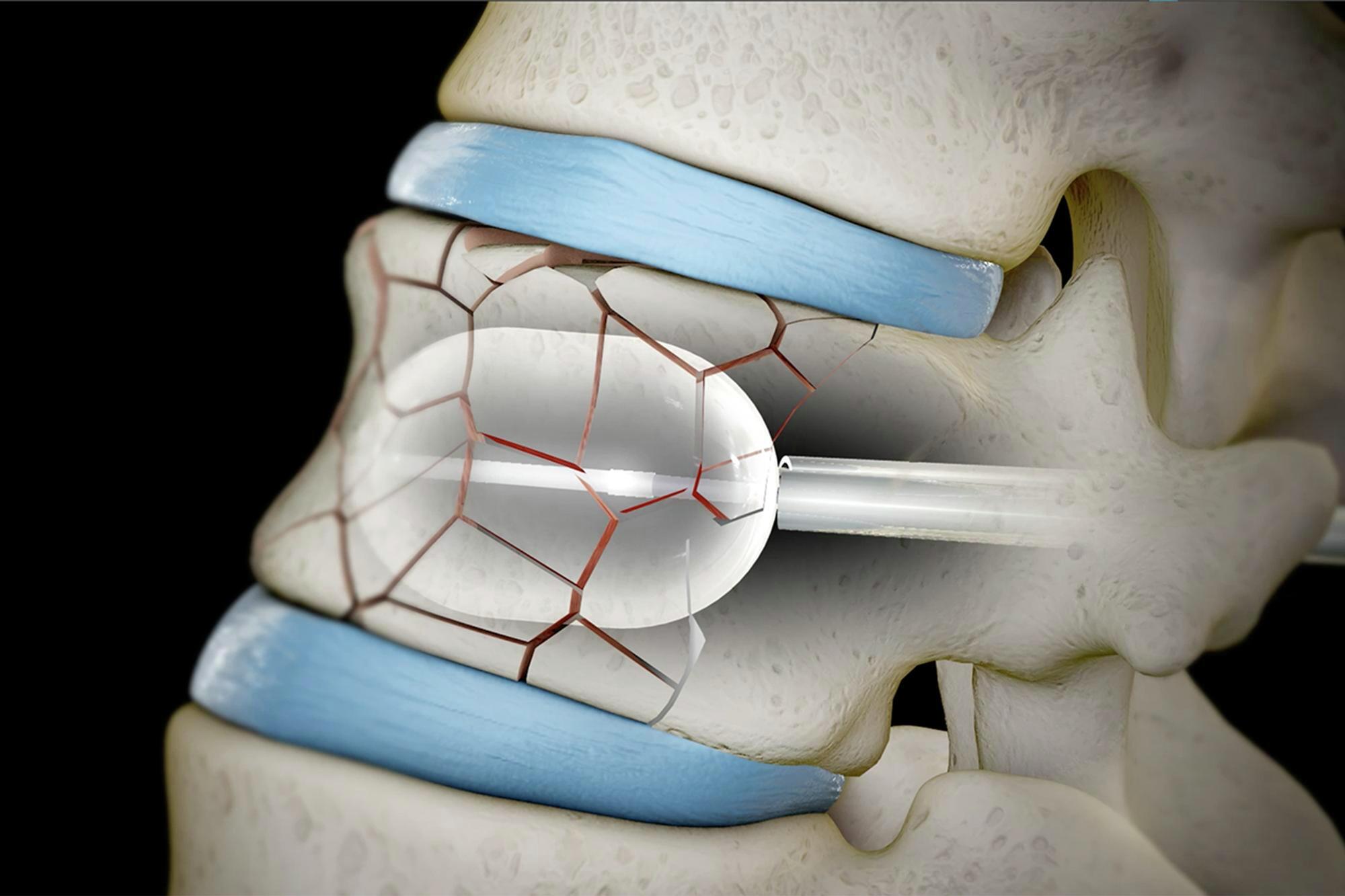 Vertebral Compression Fractures (VCF) - Treatment by Spine